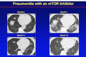 Hutson 15 Pneumonitis