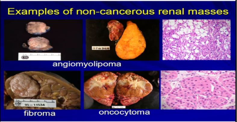 Path 5 Exp of non cancer tumors