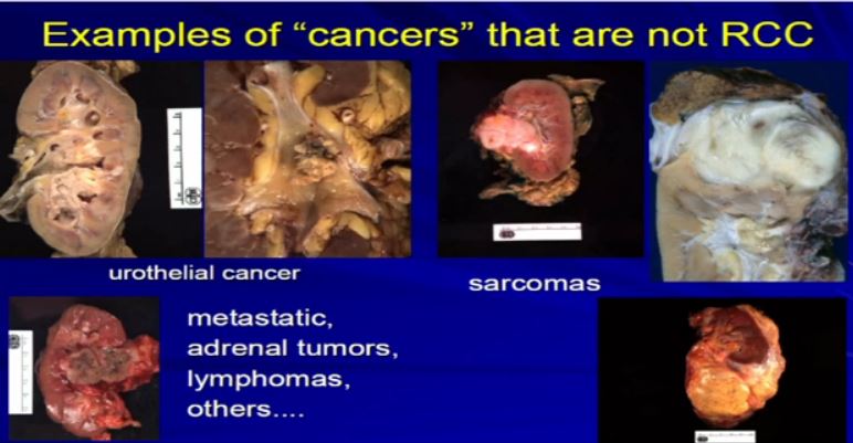 Path 6 ex of cancer not RCC