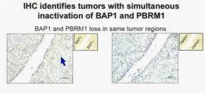 BRUG 17a IHC ids tumors Upper