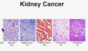 BRUG 2 Kidney Cancer subtypes