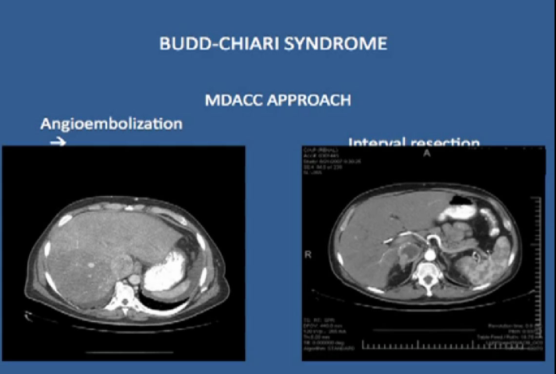 Locally Advanced RCC /Kidney Cancer; Dr. Chris Wood; Budd ... venous diagram 